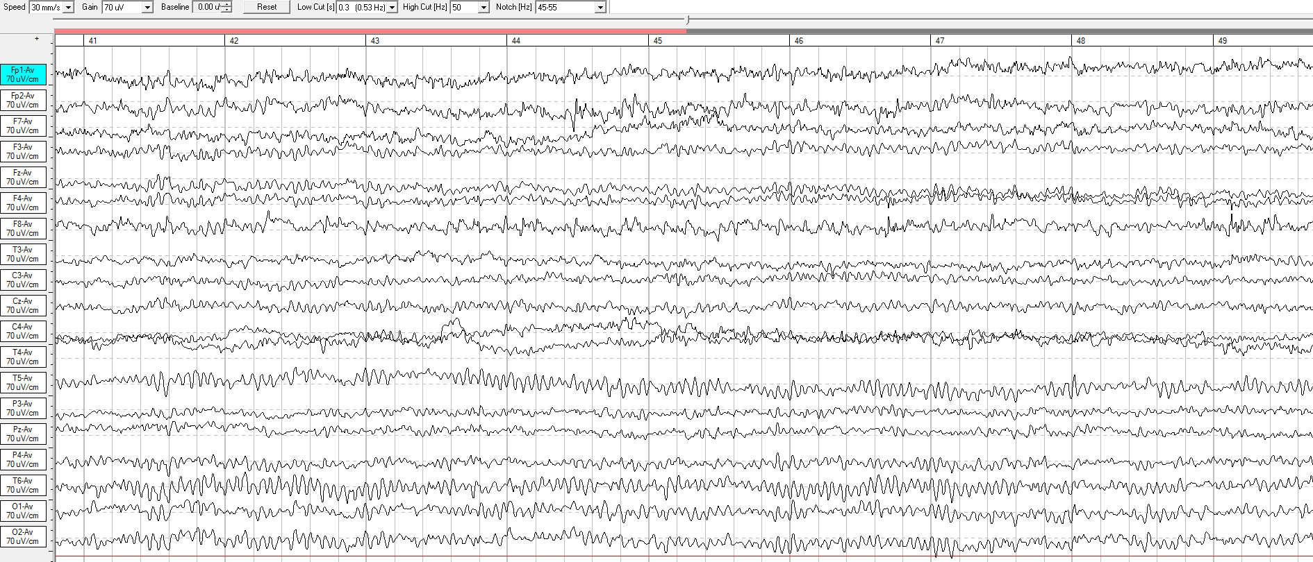 Registro EEG crudo de ojos cerrados con trazados de actividad eléctrica en múltiples canales.