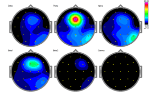Imagen de mapa cerebral ilustrando biomarcador de TDAH